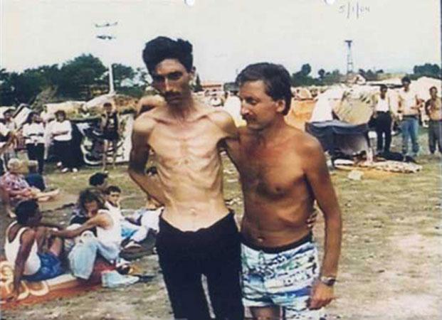 Starvation at Trnopolje Camp